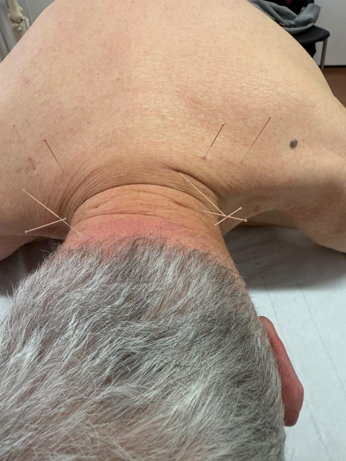Patient progress after physiotherapy treatment - Case 3