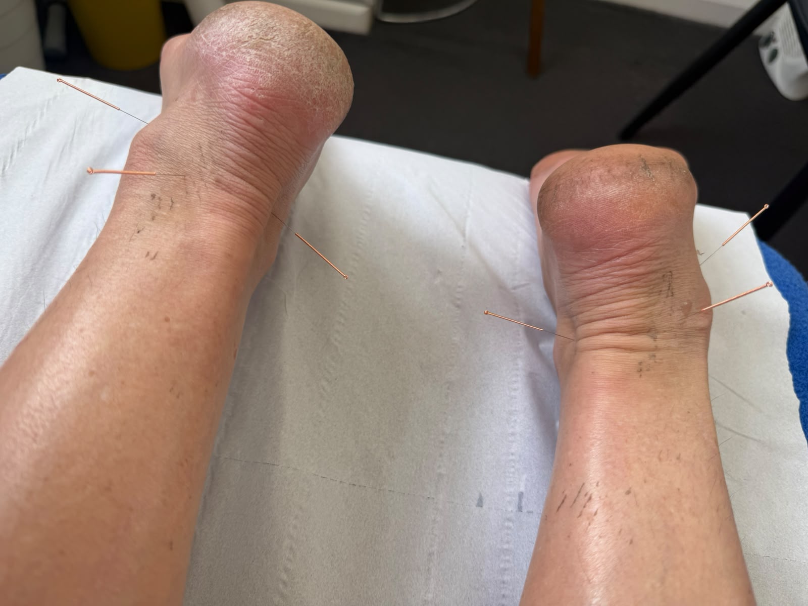 Patient progress after physiotherapy treatment - Case 4
