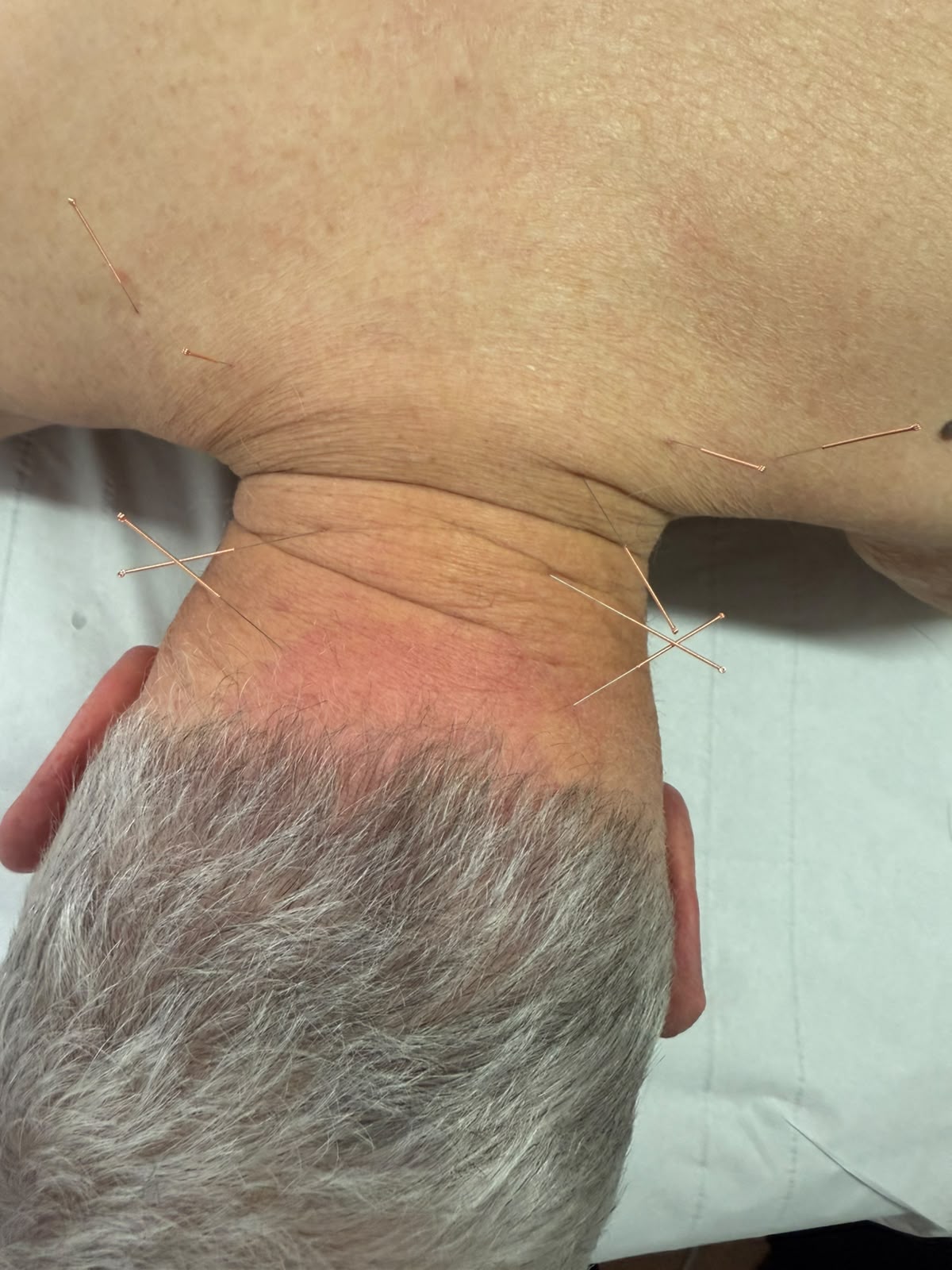 Patient condition before physiotherapy treatment - Case 3